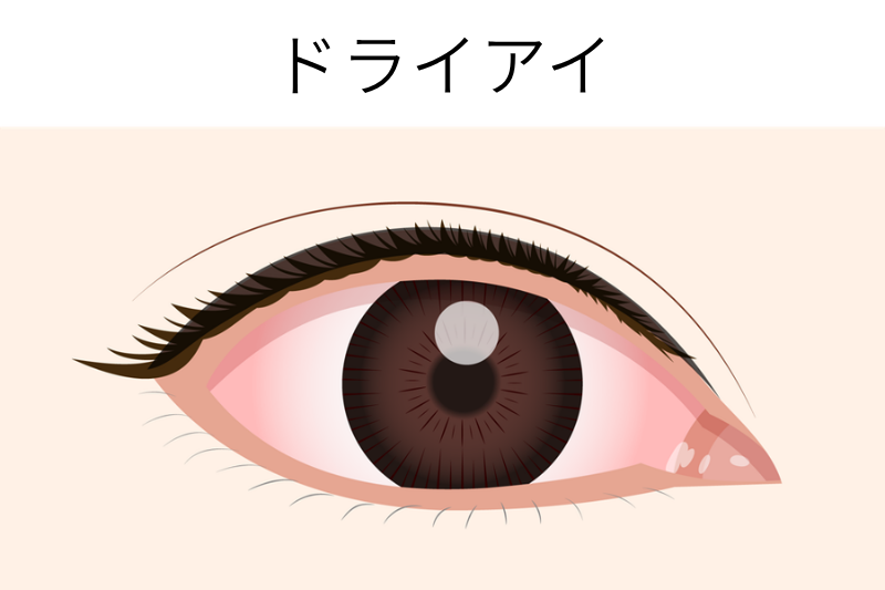 ドライアイ