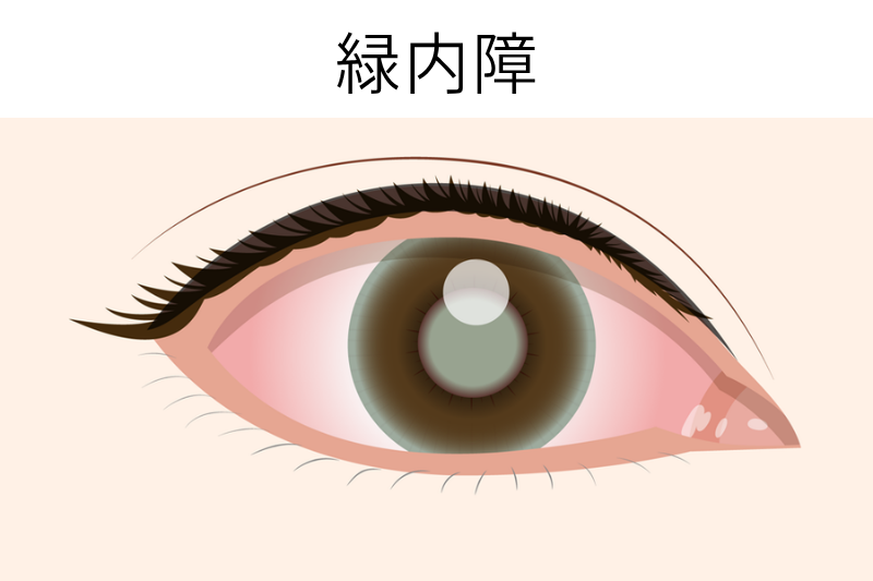 緑内障