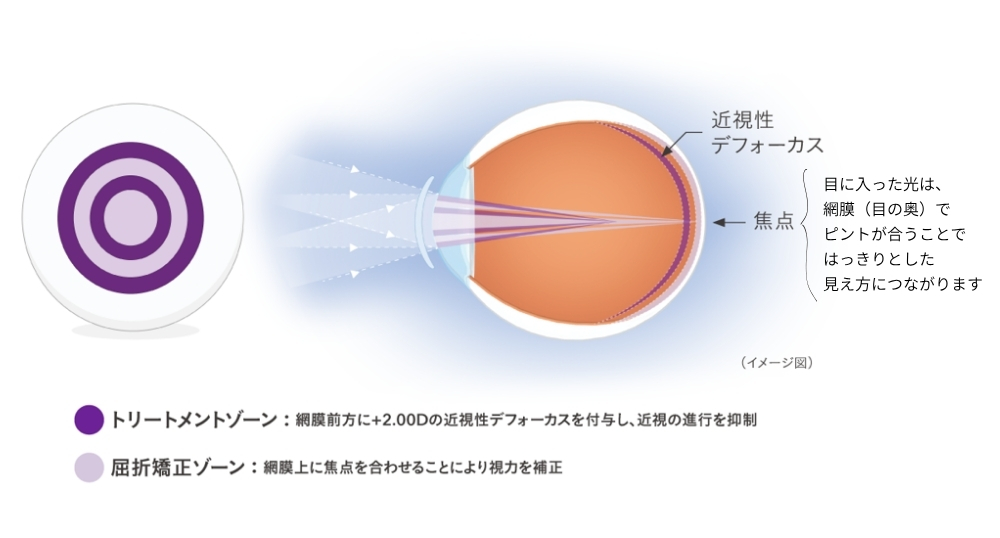 マイサイトワンデーは、独自構造（ActiveControl テクノロジー）を採用