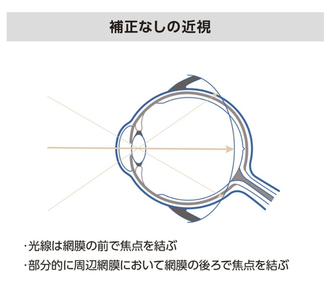 矯正なしの近視
