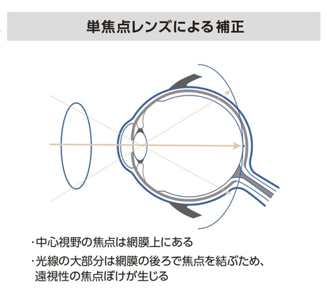 単焦点レンズによる補正